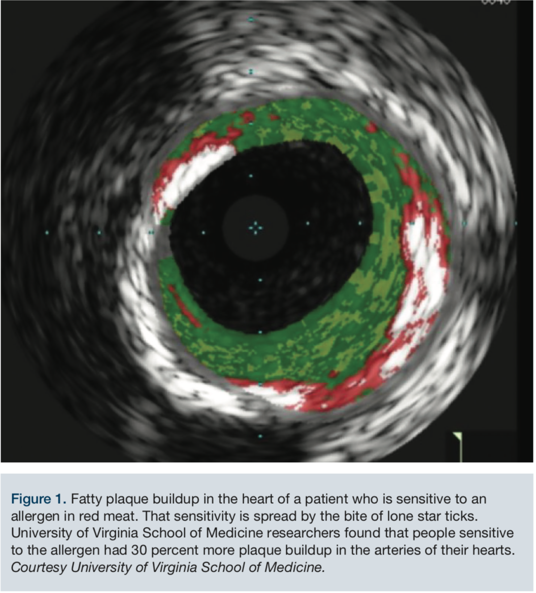 Meat Sensitivity Spread by Ticks Linked to Heart Disease